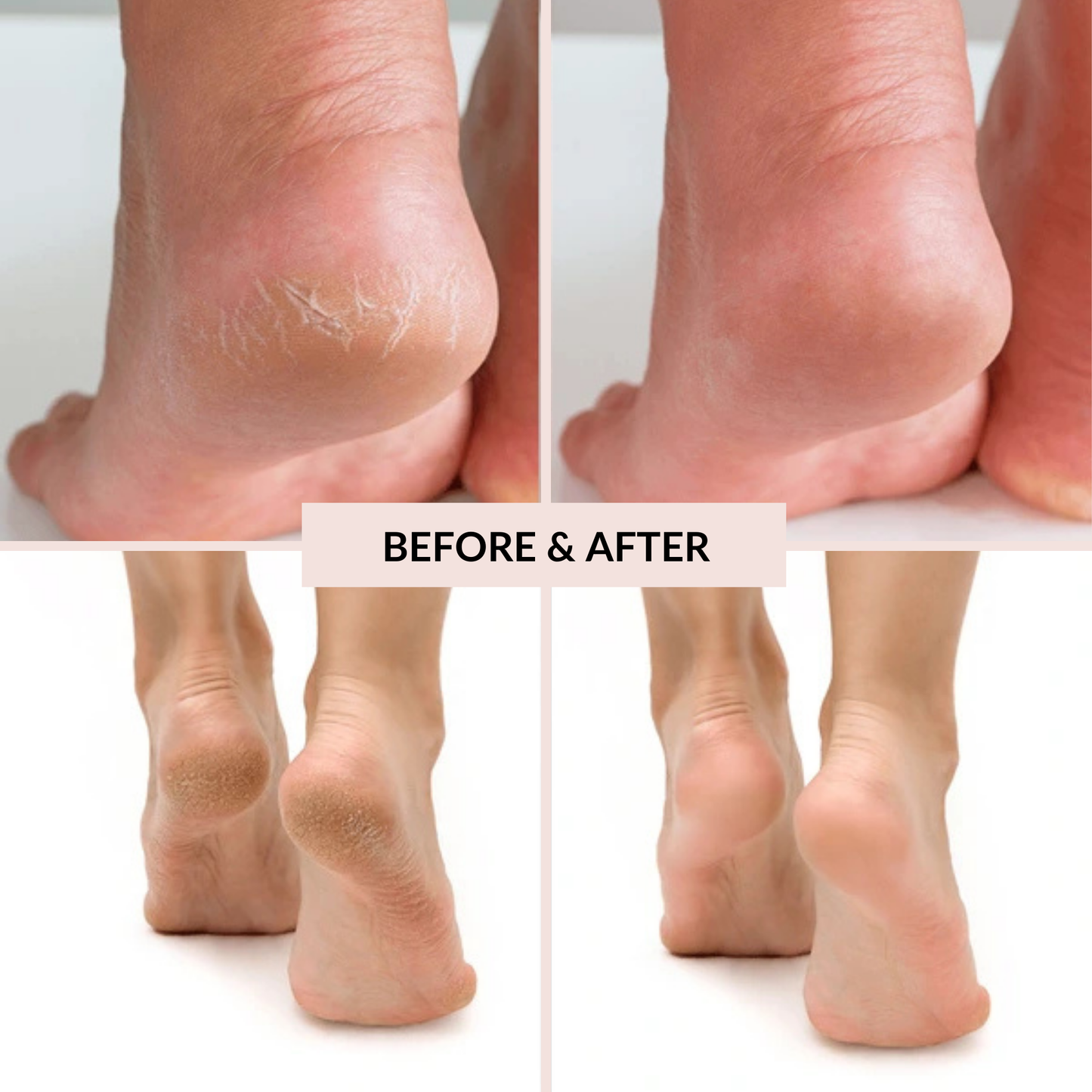 Kivara Electric Callus Remover