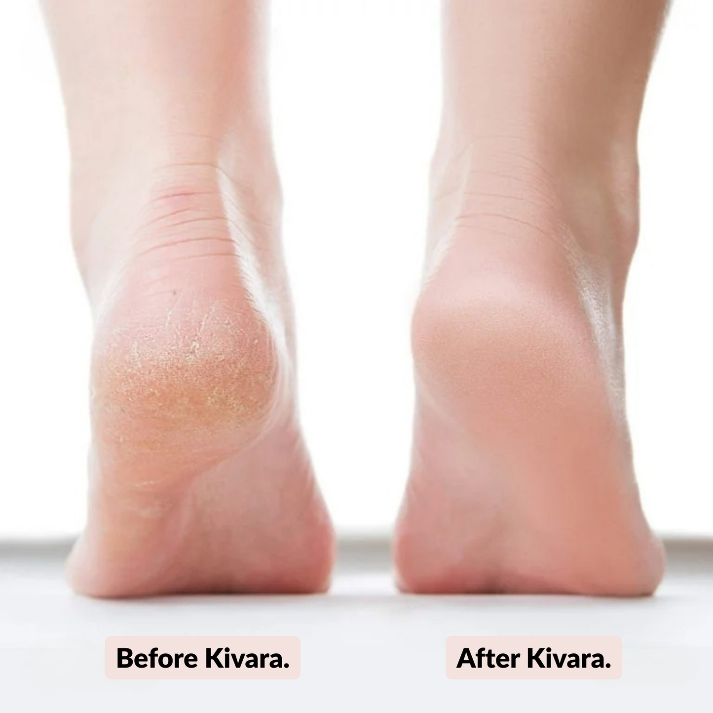 Kivara Electric Callus Remover
